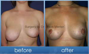 breast asymmetry 2