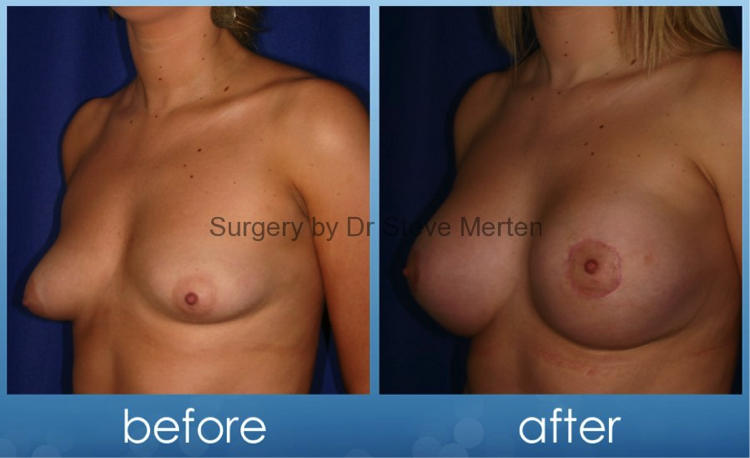 breast asymmetry
