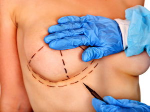 breast asymmetry sydney