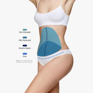 tummy tuck