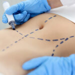 differences between abdominoplasty (tummy tuck) and liposuction