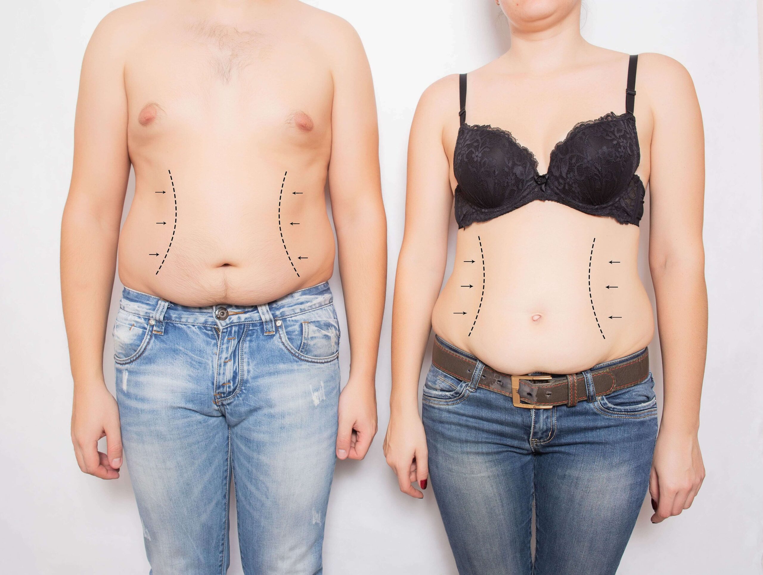 Body Contouring after Major Weight Loss - Pure Aesthetics