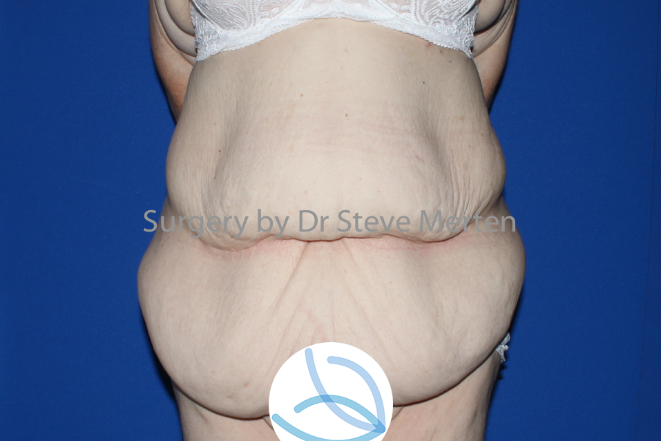 Fleur de Lis Tummy Tuck after massive weight loss by Dr Hunt in Sydney